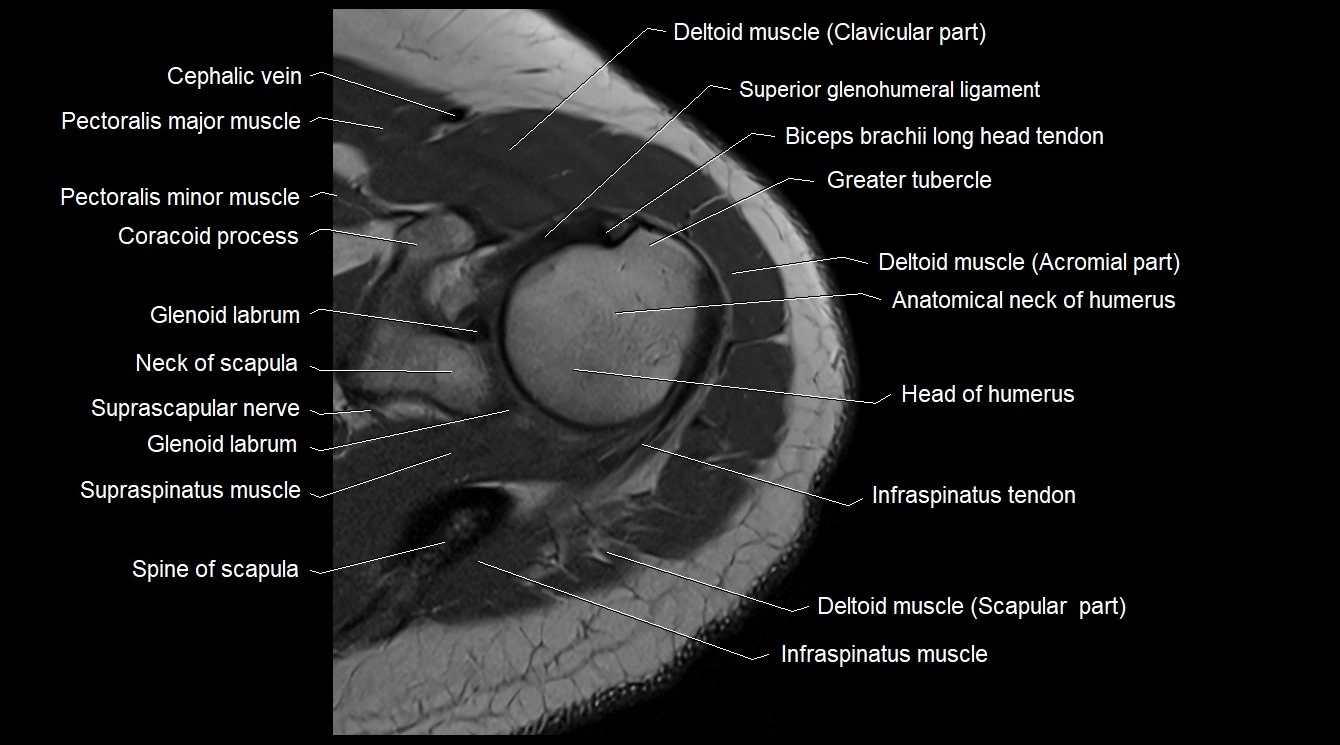 Upper arm( humerus) cross section anatomy MRI 3T axial image 9.webp